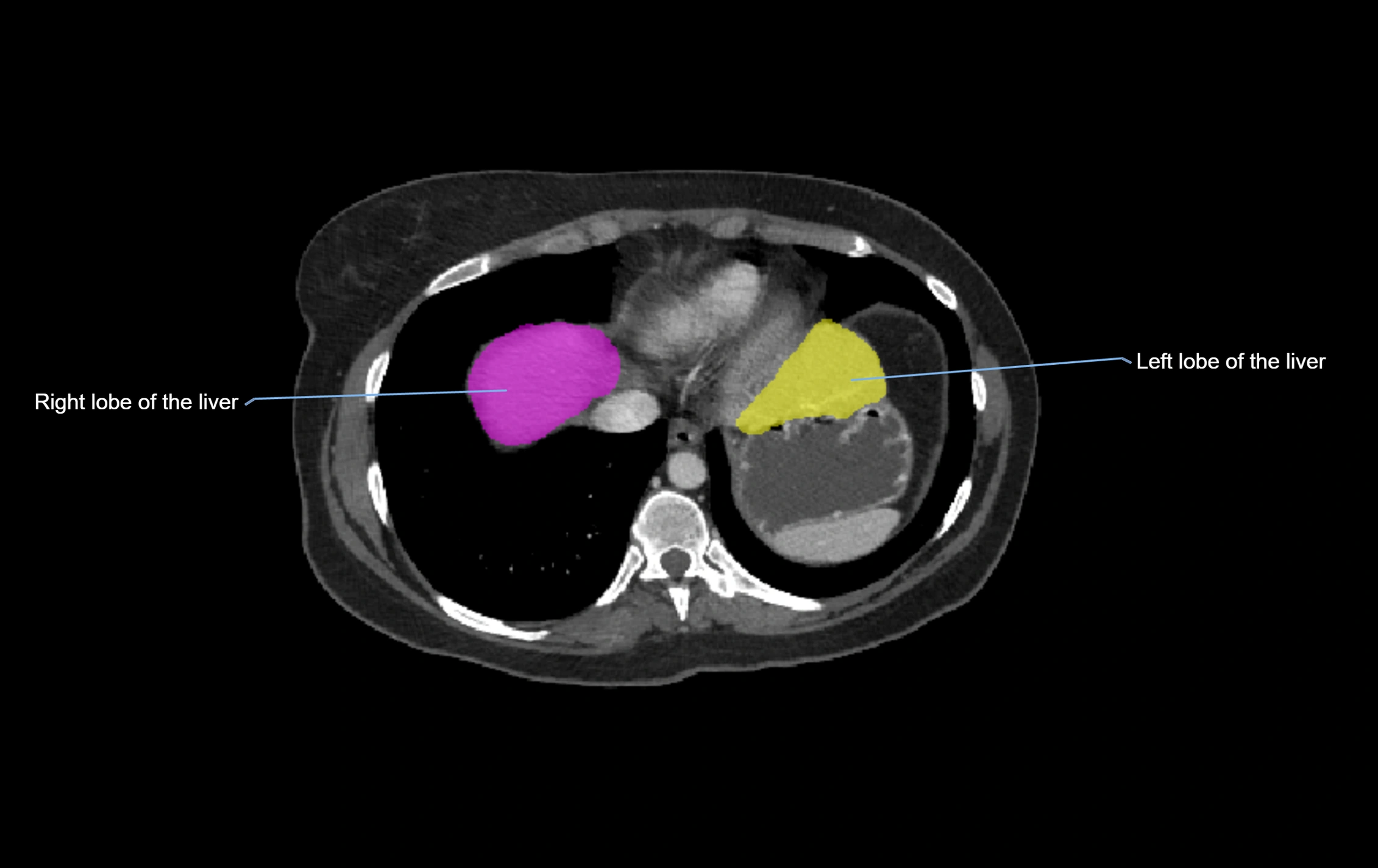 CT lliver lobes axial cross sectional anatomy labelled image -00073.webp